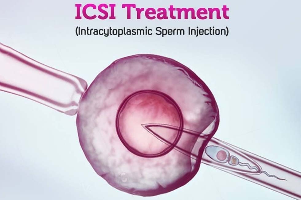 ICSI (Intracytoplasmic Sperm Injection)