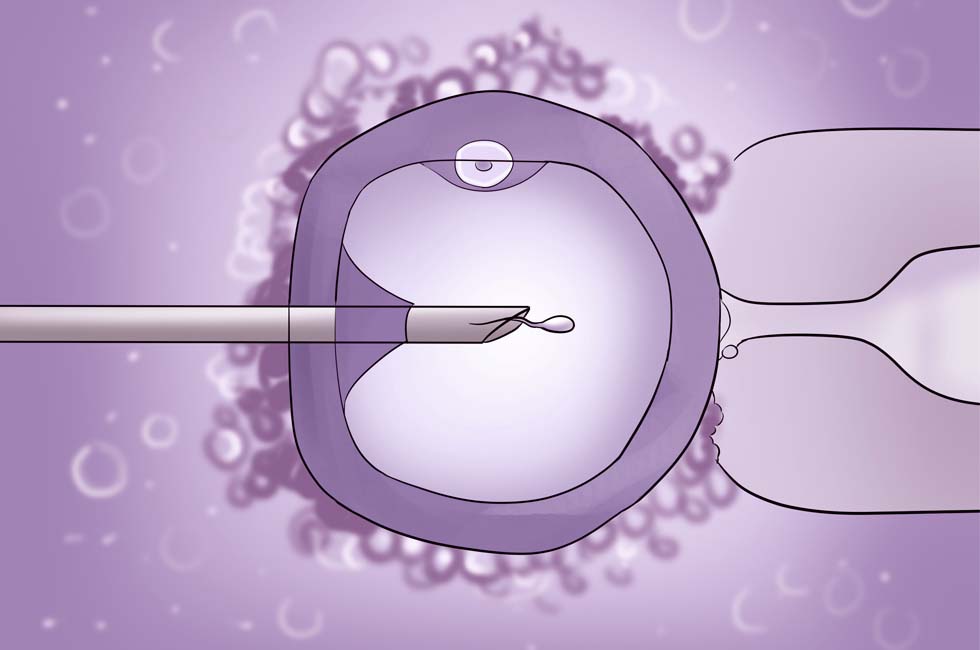 ICSI (Intracytoplasmic Sperm Injection)